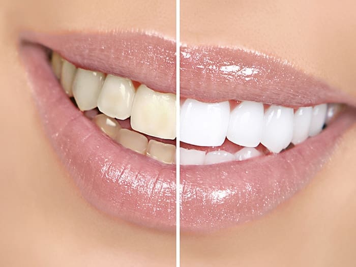 Teeth Whitening Parker CO