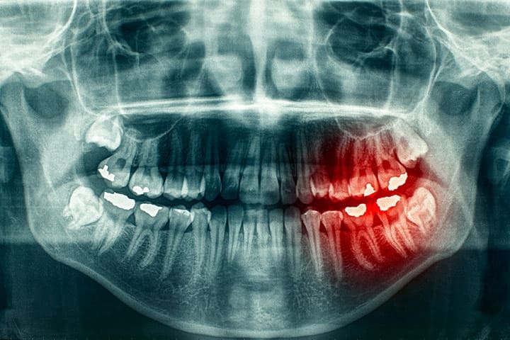 Digital Dental X-Rays Parker CO