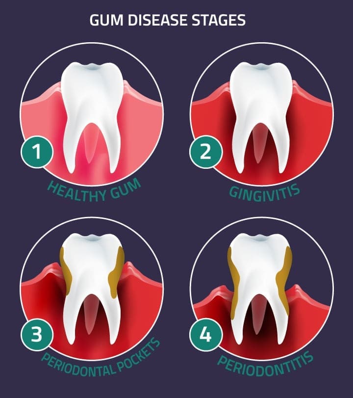 Gingivitis and Periodontitis Disease in Parker